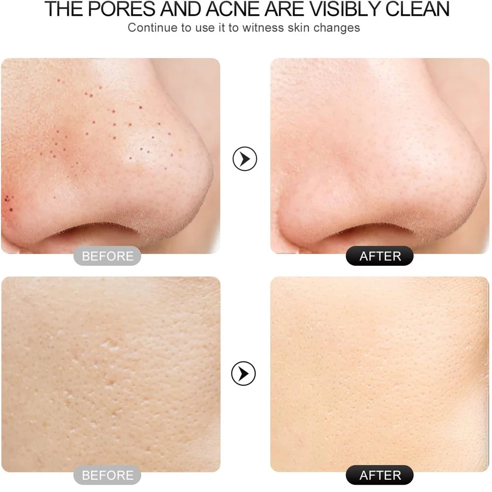 Electric Skin Scrubber Peeling Blackhead Remover